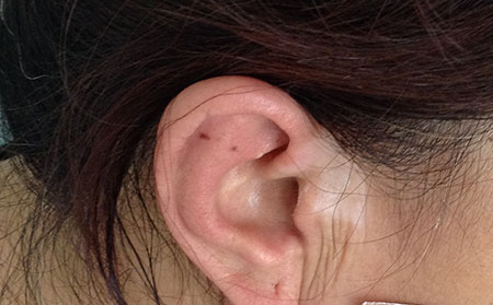 青少年患白癜風有什么危害