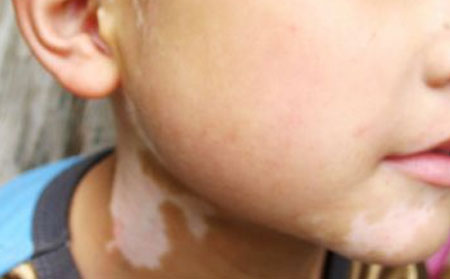 白癜風能根治嗎