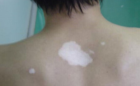 白癜風(fēng)傳染嗎,白癜風(fēng)病情是會傳染的嗎