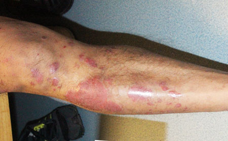 什么是銀屑病,銀屑病是什么病