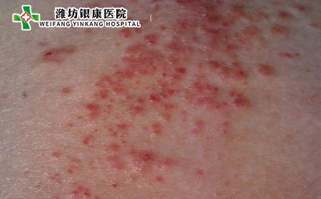 泛發性濕疹,泛發性濕疹傳染嗎