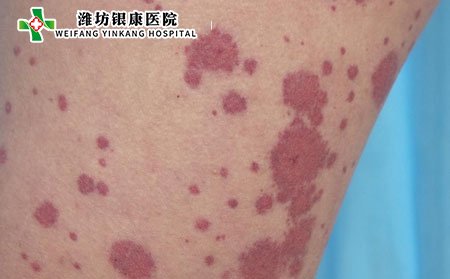 小兒過敏性紫癜的病因是什么?什么是過敏性紫癜?