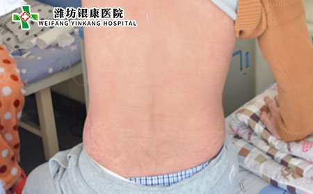 牛皮癬患者可以獻血嗎