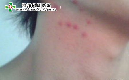 日常生活中該如何預(yù)防痤瘡?